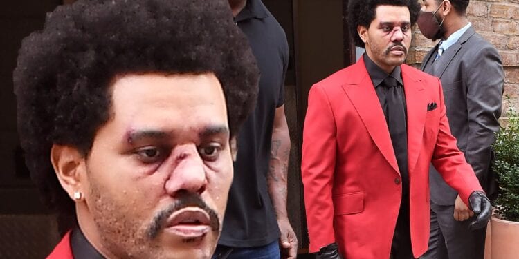 The Weekend Wears Bandages On AMA